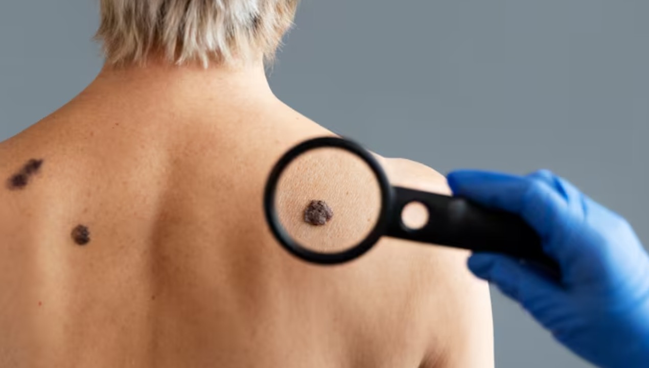 Birthmark Removal