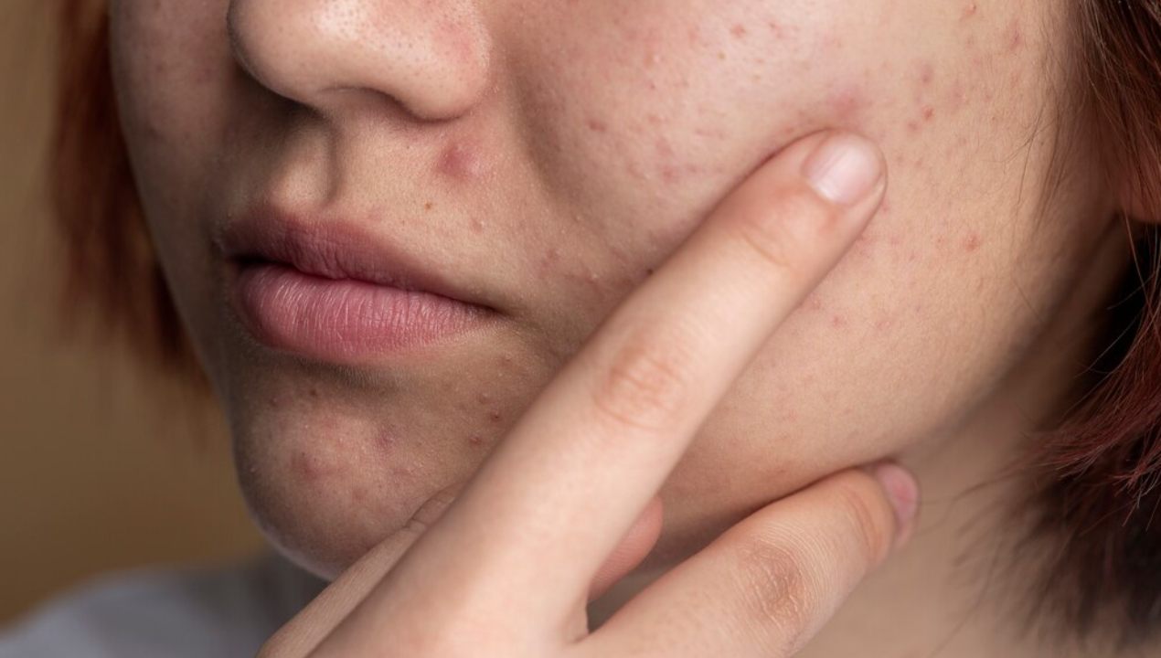 Pigmentation Peels Treatment