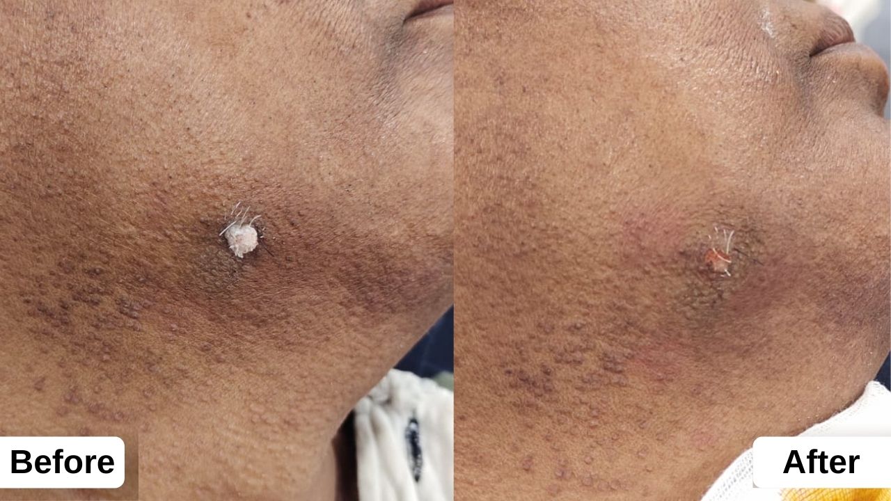 Warts: Diagnosis and Treatment - Derma Space Clinic Warts: Diagnosis and Treatment - Derma Space Clinic