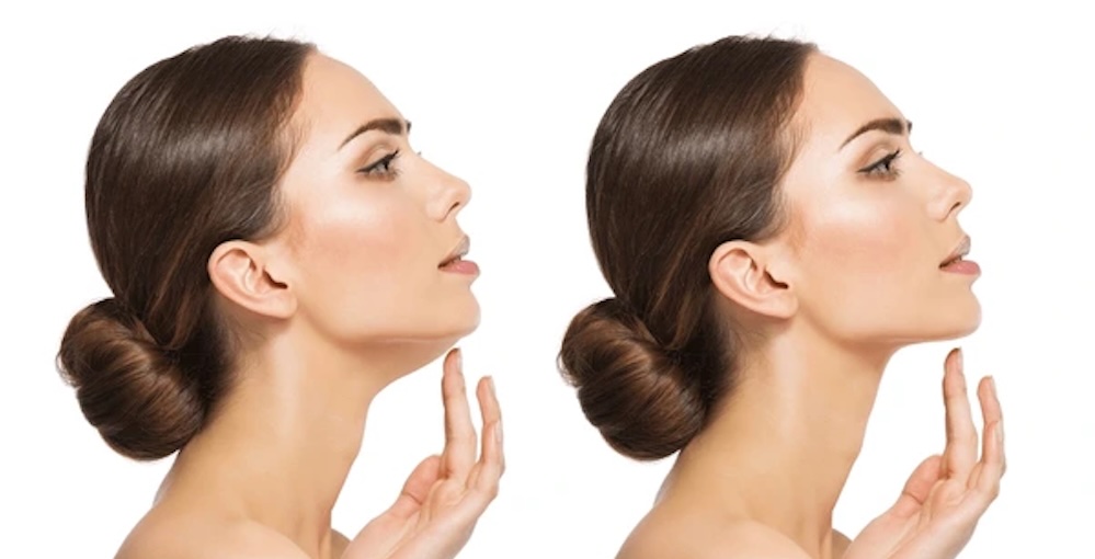 Double Chin Reduction Treatment